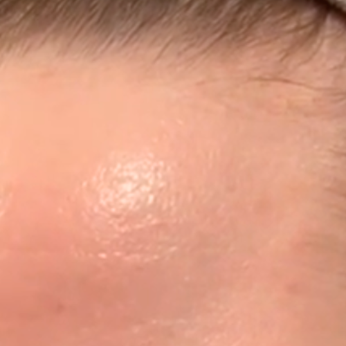 no breakouts after 1 month of GRAES Night C.A.P.